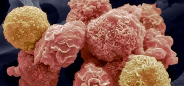 سرطان قابل پیشگیری است