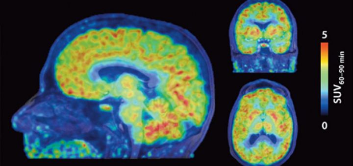 فعالیت ژن در مغز انسان