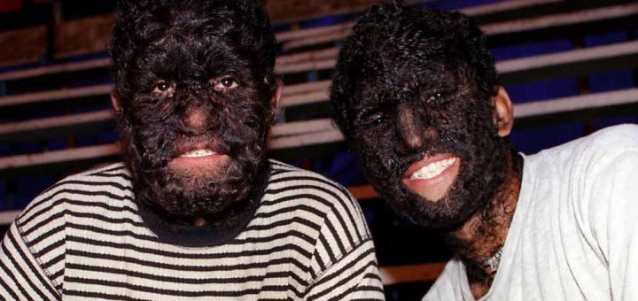 سندرم گرگینه