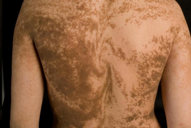 بیماری خطوط بلاسکو