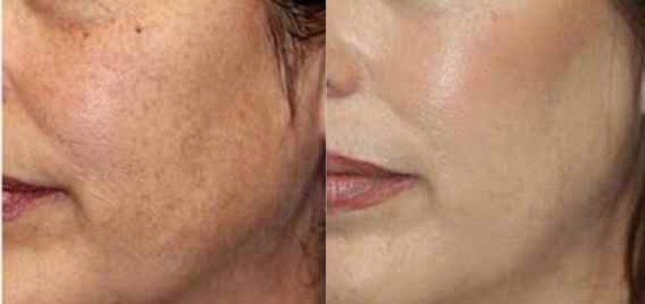 از بین بردن لکه‌های پوستی