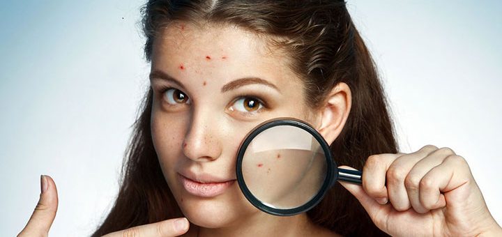 درمان جوش صورت