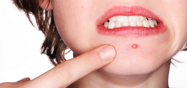 درمان جوش صورت