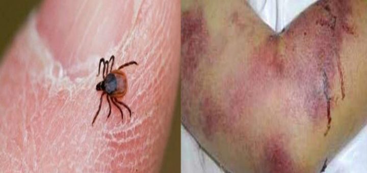 تب کریمه کنگو چیست و چطور از آن پیشگیری کنیم