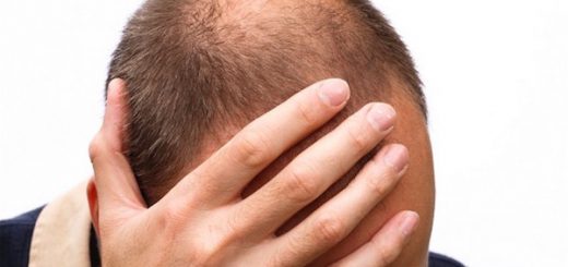 جلوگیری از ریزش مو در آقایان