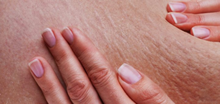 درمان سلولیت