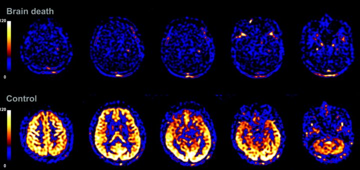 اسکن‌های کامپیوتری از فعالیت مغز یک بیمار، قبل و بعد از مرگ مغزی