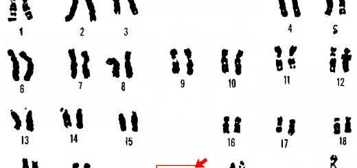 سندوم داون، از یک نسخه اضافی از کروموزوم شماره ۲۱ ناشی می‌شود.