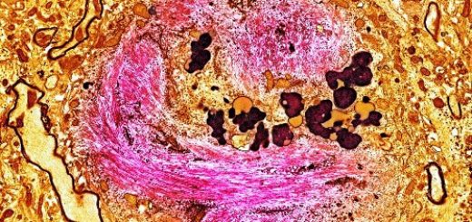 تجمع پروتین‌ها که توده‌هایی را کنار سلول‌های عصبی تشکیل می‌دهند که نهایت منجر به مرگ سلول عصبی و زوال مغز در بیماری آلزایمر می‌شود.