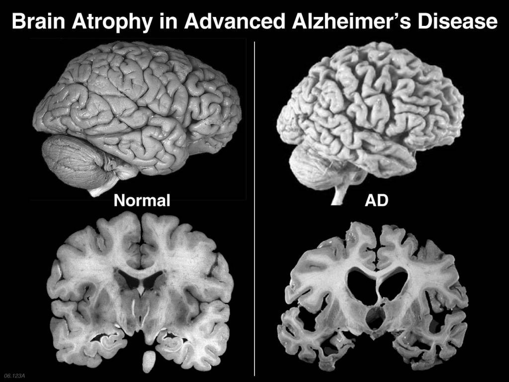 مقایسه کالبدشکافی مغز بیمار مبتلا به آلزایمر و مغز سالم