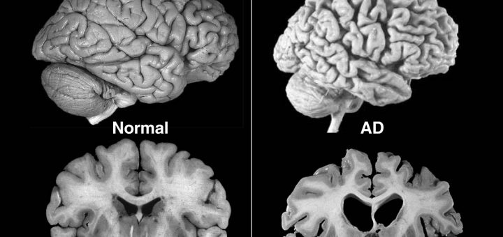مقایسه کالبدشکافی مغز بیمار مبتلا به آلزایمر و مغز سالم