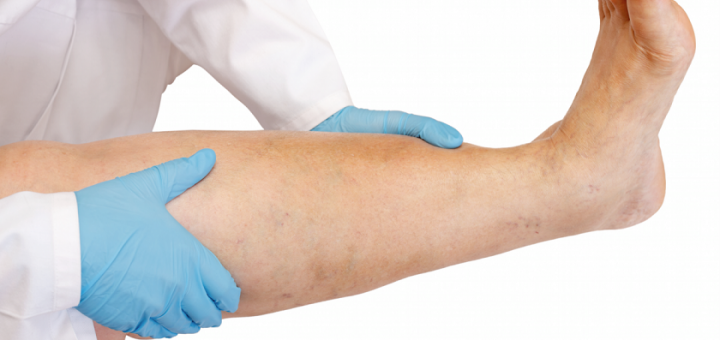 بیماری رگ‌های محیطی