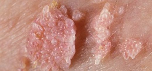 زگیل‌های تناسلی زائده‌های گوشتی کوچکی هستند که ممکن است در هر قسمتی از ناحیه تناسلی زن یا مرد ظاهر شوند. عامل این بیماری ویروس پاپیلومای انسـانی است که از طریق تماس مستقیم با زگیل تناسلی یا پوست آلوده به ویروس و اغلب از طریق ارتباط جنسی منتقل می‌شود.