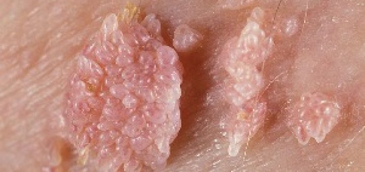 زگیل‌های تناسلی زائده‌های گوشتی کوچکی هستند که ممکن است در هر قسمتی از ناحیه تناسلی زن یا مرد ظاهر شوند. عامل این بیماری ویروس پاپیلومای انسـانی است که از طریق تماس مستقیم با زگیل تناسلی یا پوست آلوده به ویروس و اغلب از طریق ارتباط جنسی منتقل می‌شود.