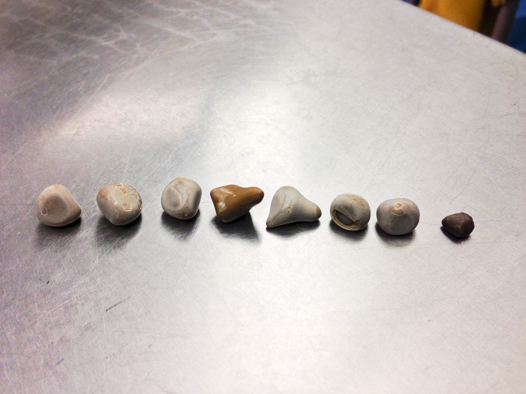 سنگ‌های کلیه