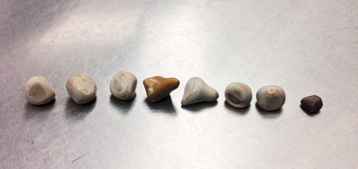 سنگ‌های کلیه