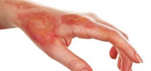 انواع سوختگی