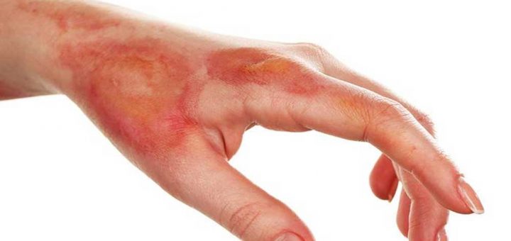 انواع سوختگی