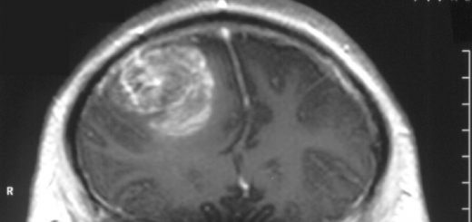 سرطان مغز در پسر ۱۵ ساله (Gliobastoma)