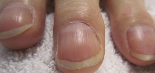 ناخن‌های چماقی