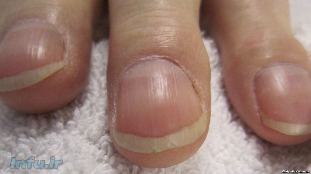 ناخن‌های چماقی