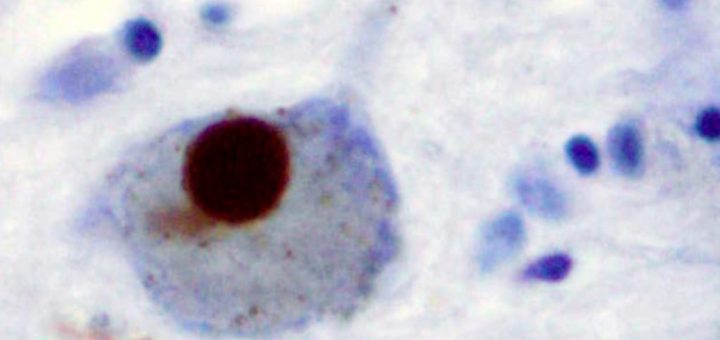 یک جسم لوی (دانه‌ی غیرعادی پروتئین) در سلول عصبی بیماری پارکینسون