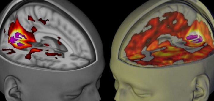مغز تحت تاثیر تلقین(چپ) و مغز تحت تاثیر ال‌اس‌دی(راست)