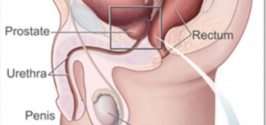 سرطان ثانوی
