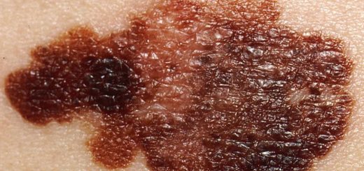 تومور پوستی