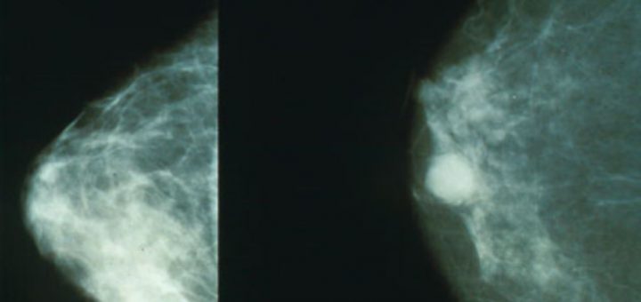 پستان سرطانی(راست)