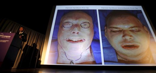 دکتر رودریگوز در کنفرانسی پس از پیوند صورت (تصویر صورت آتش‌نشان داوطلب، پیش و پس از جراحی)