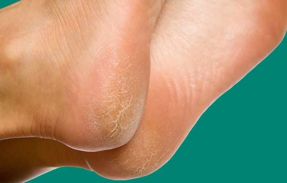 ترک پاها 7-reasons-your-feet-are-peeling,علت ترک کف پا