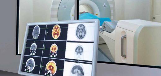 اسکن MRI از مغز