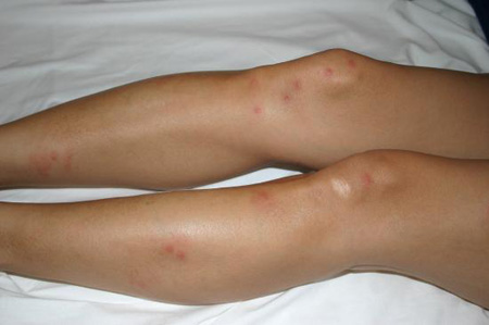 ضد خارش کک| آشنایی با کک