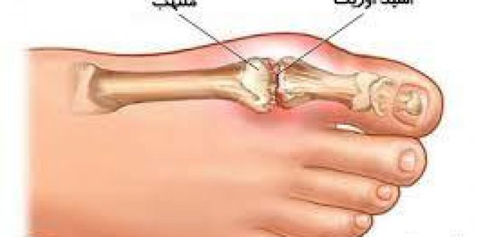 درمان نِقرس