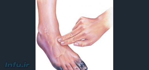 درماتوفیتوز